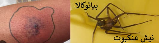 نیش عنکبوت